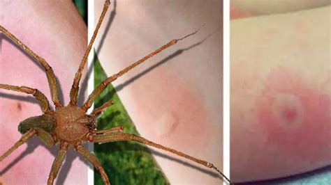 La picó una araña violinista asesina en Ibiza y se salvó de la ...